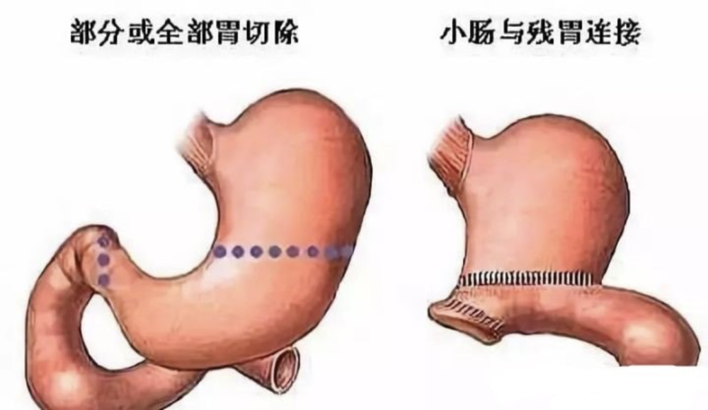 你的慢性胃炎為何反覆發作細究原因