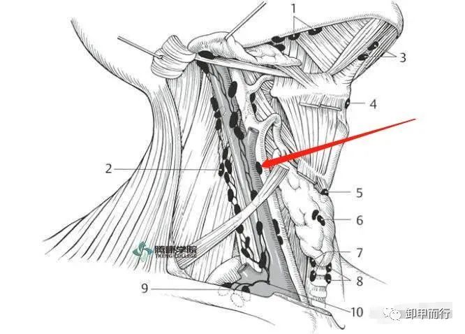 圖說05甲狀腺癌頸部淋巴結跳躍性轉移規律及原理