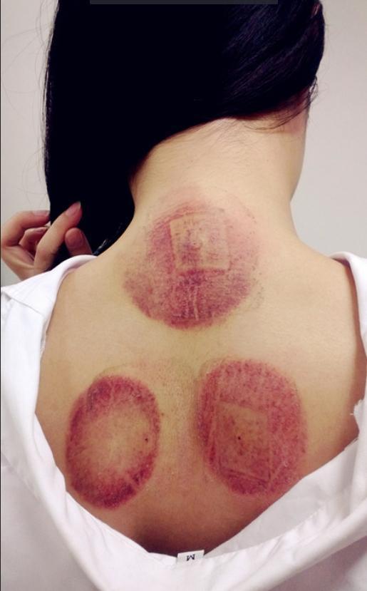 其实在拔罐之后身上出现不同的红紫情况并不是我们体内的毒素被拔了