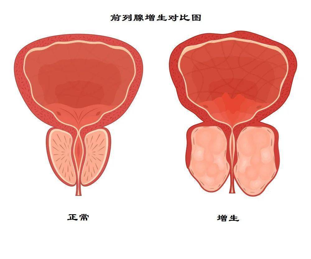 男性前列腺在什么位置？为什会增生？ 腾讯新闻