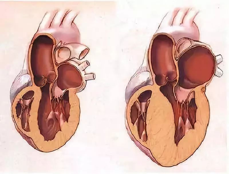 左心室肥大怎么办图片