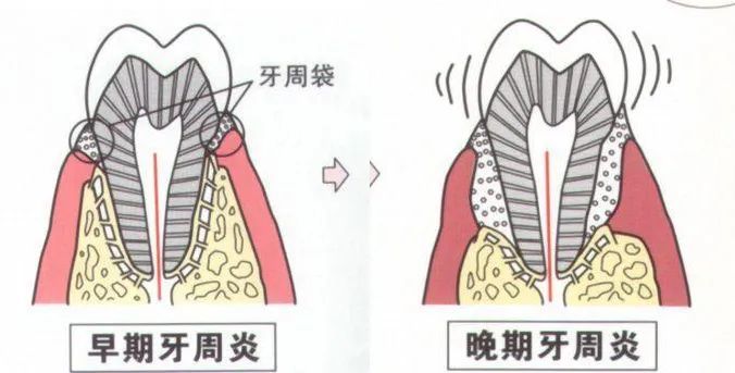 急性根尖周炎急性根尖周炎,頜骨骨髓炎,頜骨內腫瘤均可引起病牙的牙齒