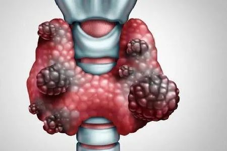 甲状腺结节出现恶变征象"钙化",你慌不慌?