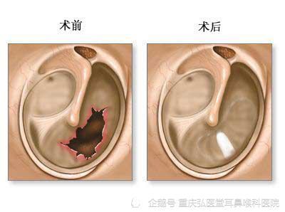 鼓膜标志图片