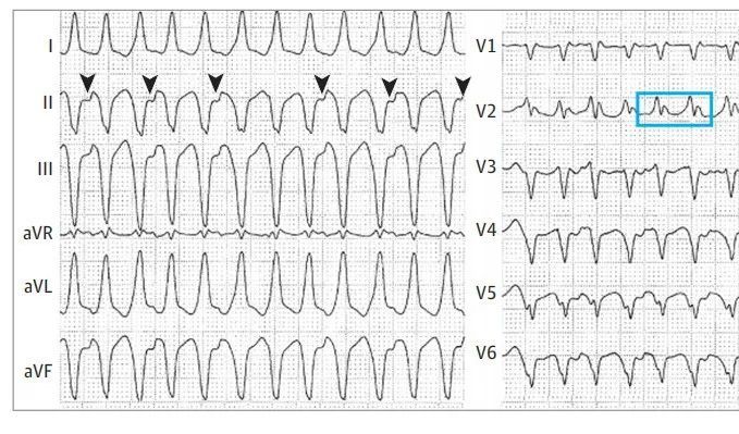 从患者的心电图来看,呈现宽qrs心动过速,胸导联的qrs波的几乎一致负向