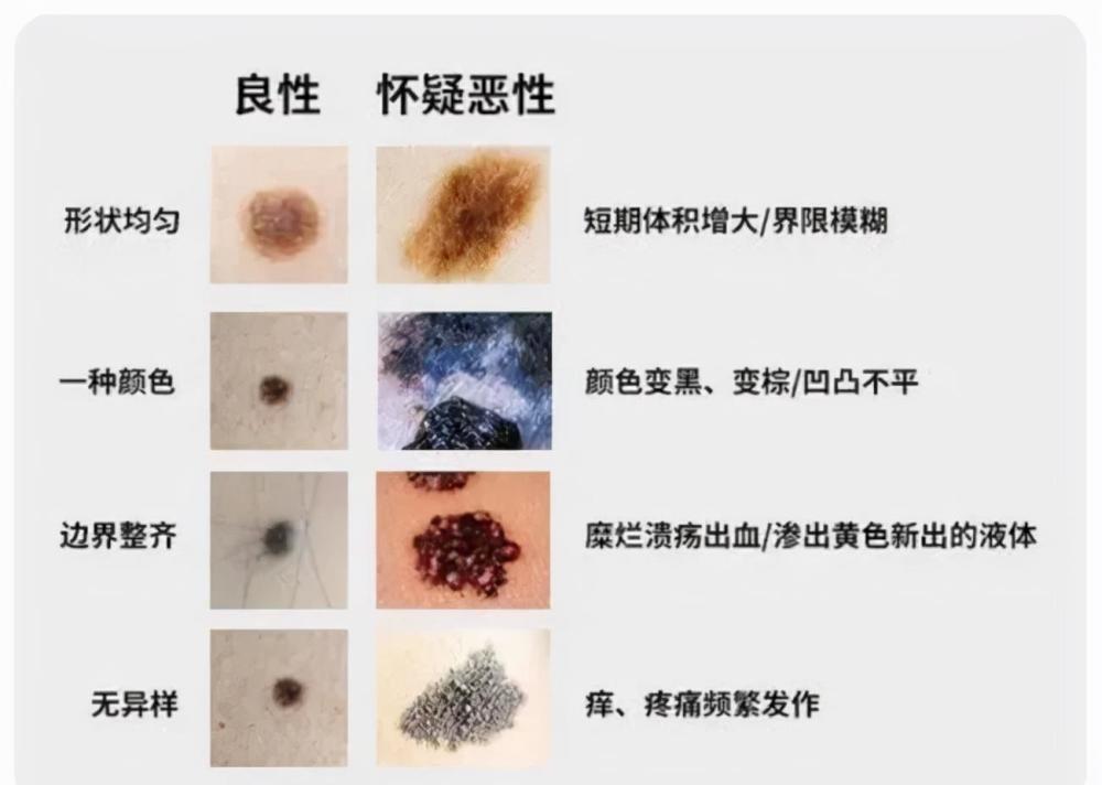 你身上有這些痣嗎?_騰訊新聞