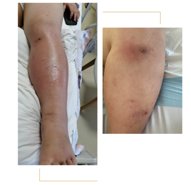 可怕!被蚊子咬了一口,38周孕妇感染这病,差点危及胎儿