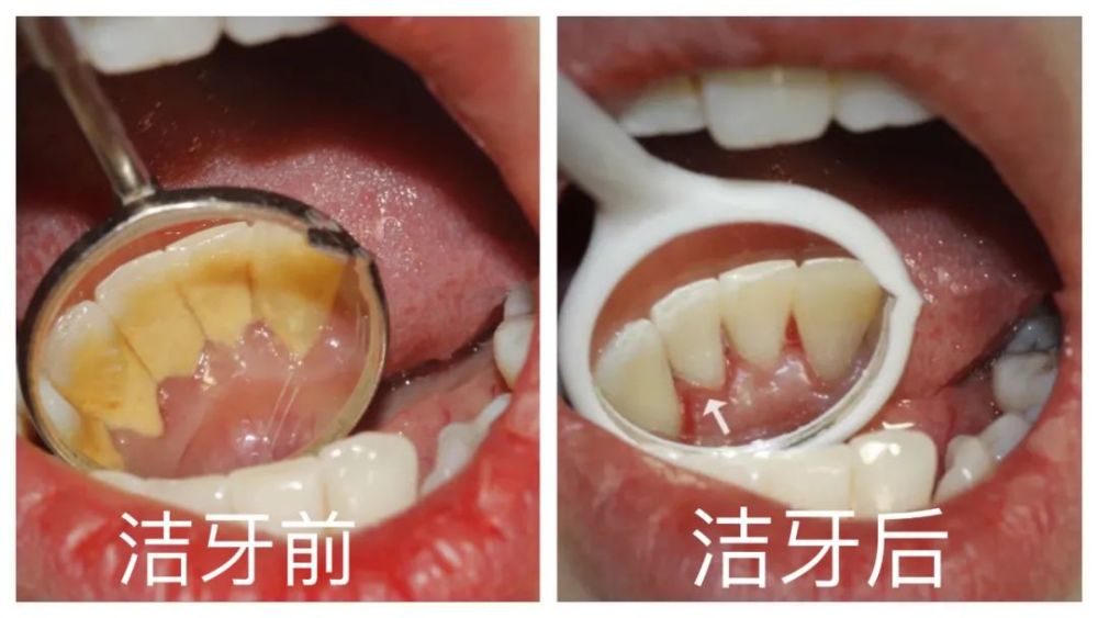 但有些患者還會有大量牙結石存在於牙齦深部牙周袋內,需要進一步的