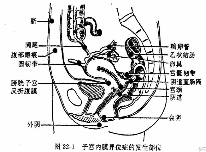 除了子宮,內異症還能長到哪些部位?