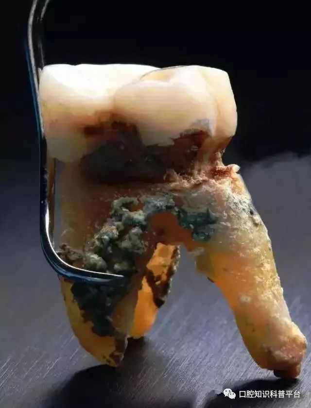 牙医给自然脱落的牙齿拍微距照片 万万没想到