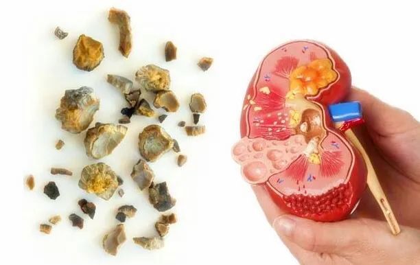 吃不对,当心结石复发|尿路感染|磷酸钙|结石|尿路结石
