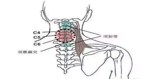 颈部肌筋膜性疼痛_腾讯新闻