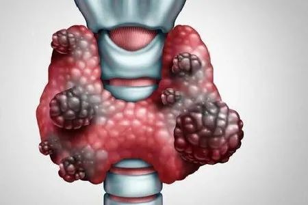 武漢仁愛醫院甲狀腺專科李豔萍主任提醒:甲狀腺結節出現惡變徵象