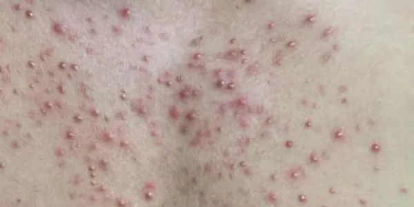 后背长疙瘩这4个原因不可忽略