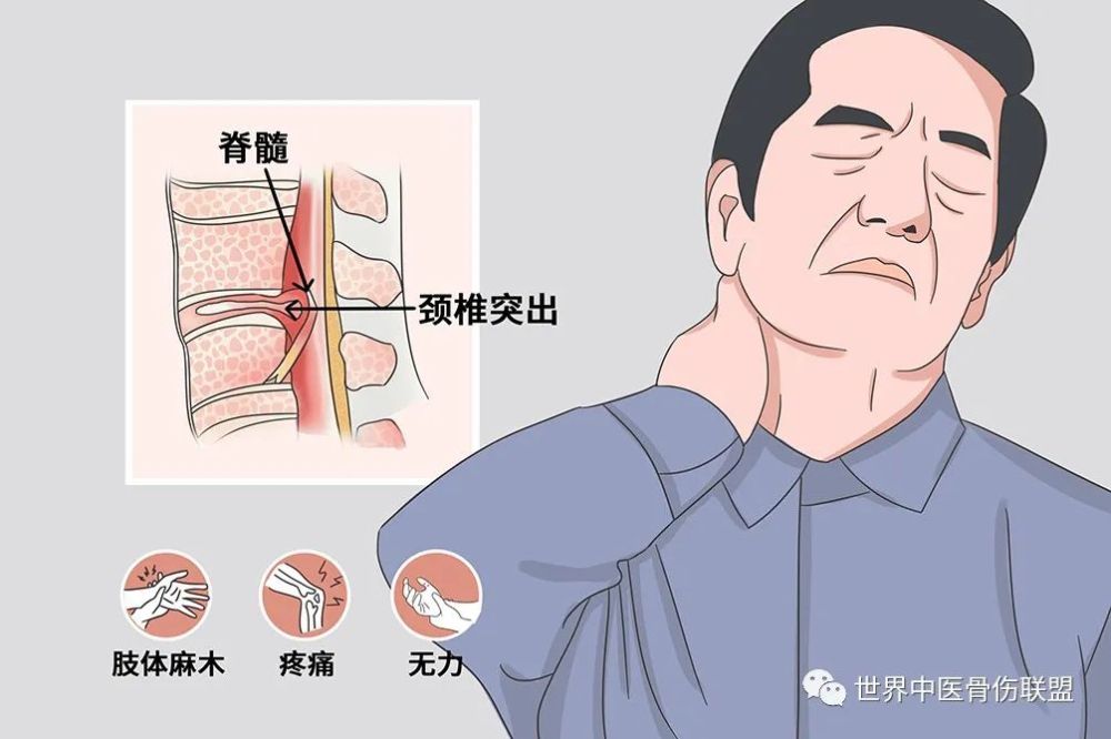 脊髓型頸椎病