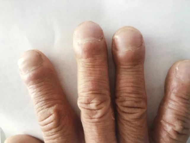 手指头圆圆鼓鼓的有一种情况要留意