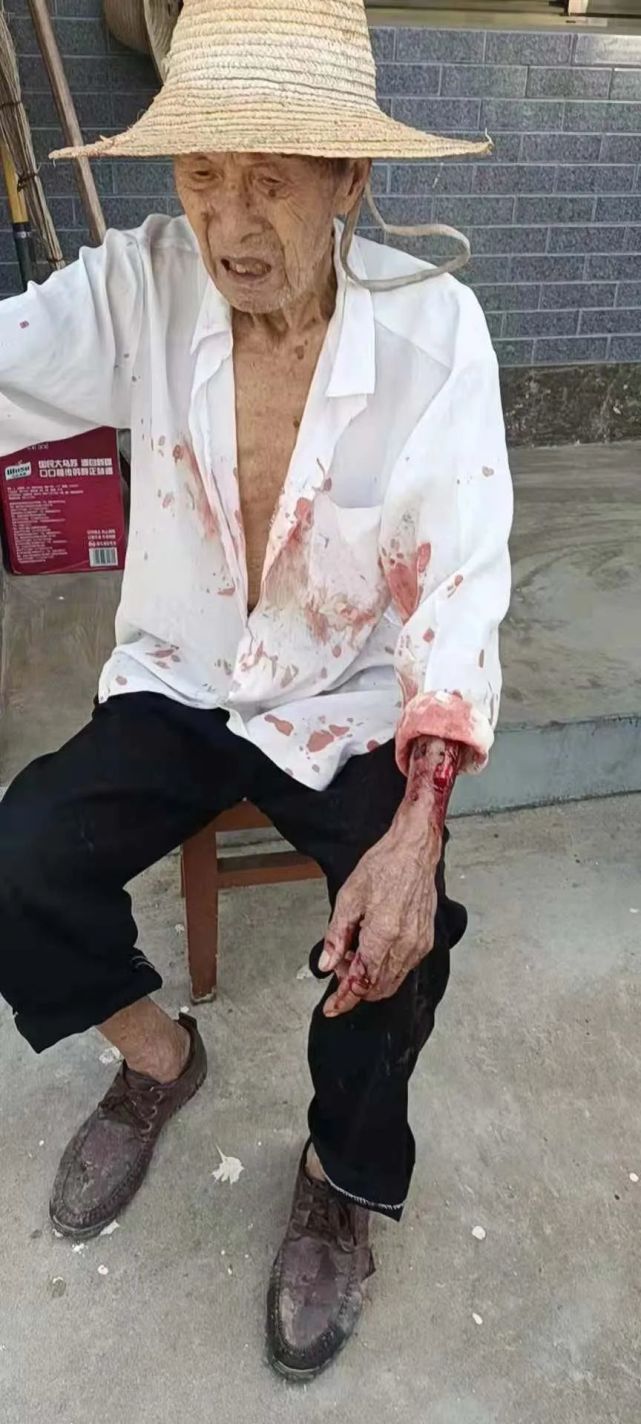 惨不忍睹安庆一恶犬咬伤一老人