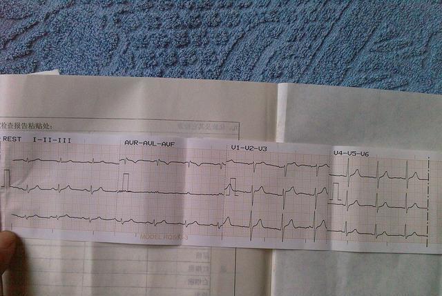 一份幾乎正常的心電圖但醫生卻堅稱她有病