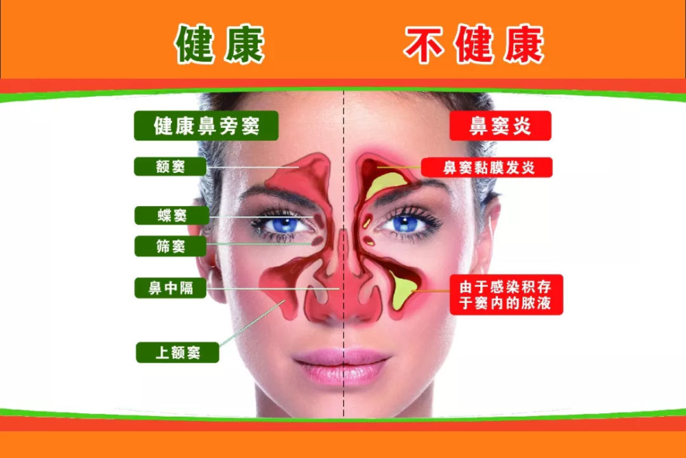 鼻窦炎如果我们有鼻炎的情况下,这个鼻炎的黏膜和鼻窦的黏膜呢它是