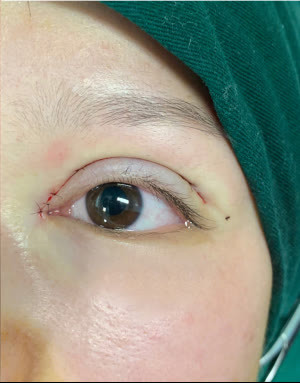 上海九院博士孙沣:如何改善眼裂狭小,让她来告诉你!