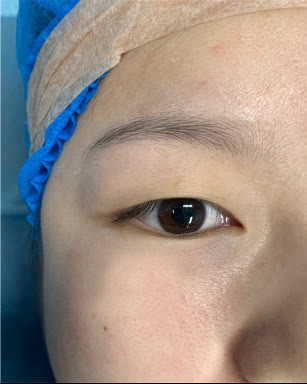 上海九院博士孙沣:如何改善眼裂狭小,让她来告诉你!