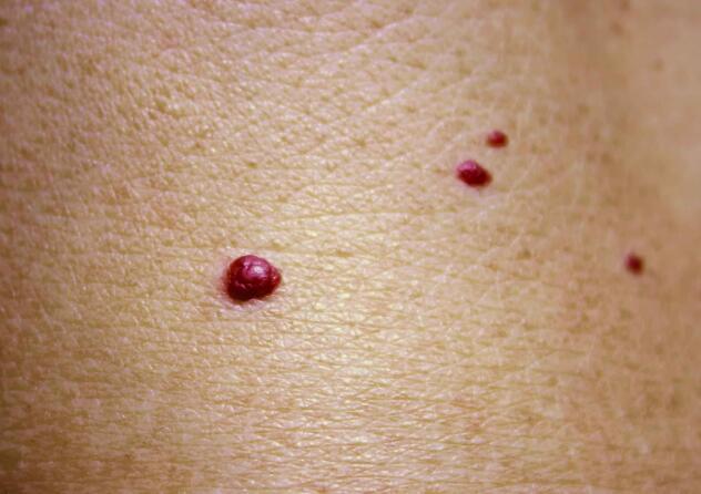 朱砂痣是肝硬化到来的表现吗提醒与肝硬化有关的是蜘蛛痣