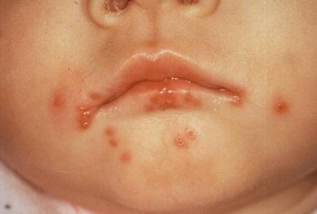 用药指南口腔单纯性疱疹这样用药好的快