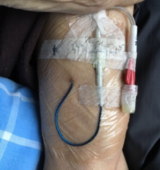 导管外移目前有关 picc 导管脱出的判断还没有统一的标准, 脱出的诊断