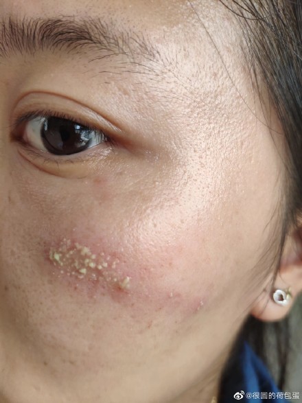 一条虫子竟然上了热搜遇到隐翅虫该怎么办