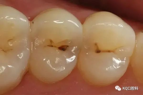 牙齿上的小黑点为什么会成为很多人的噩梦开始