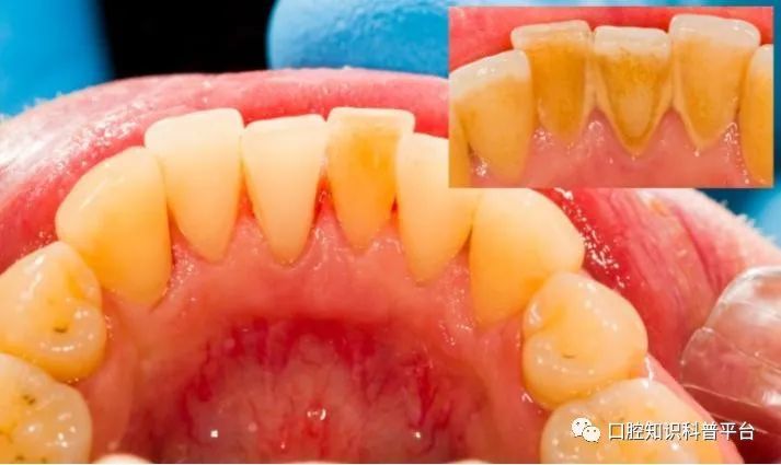 天天都認真刷牙,為什麼這個部位愛長牙結石?_騰訊新聞