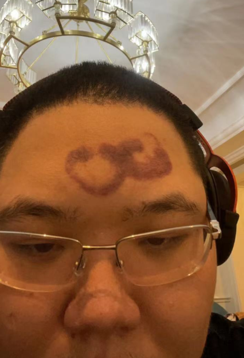 此外,宁狮狮还晒出了pdd脑门的疤痕.