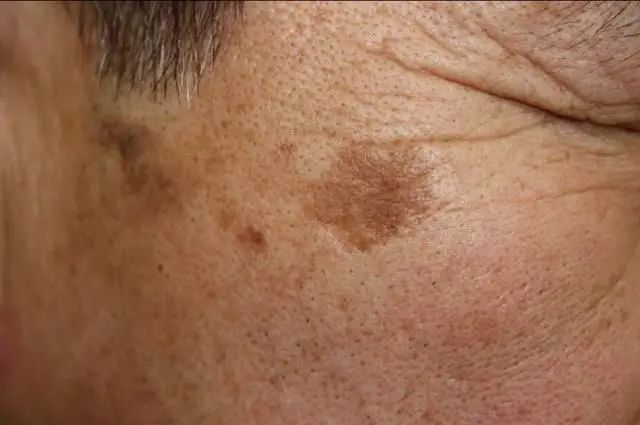 做好四件事,老年斑可有效改善!