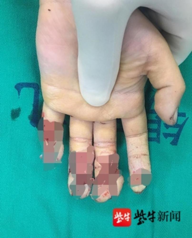 不知道怎么回事近期儿童手指被压断事故频发