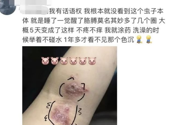 不少网友都表示被隐翅虫叮咬过,热搜话题下,就医后确诊为隐翅虫皮炎