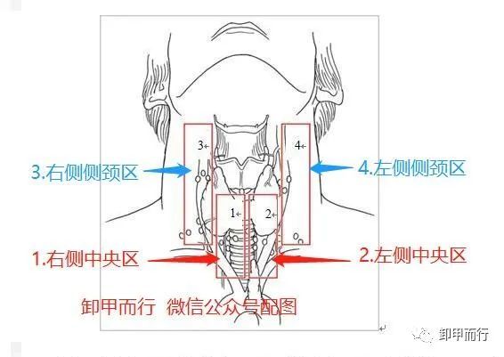 【图说09】满分的甲状腺癌颈部中央区(vi区)淋巴结清扫是什么样的?