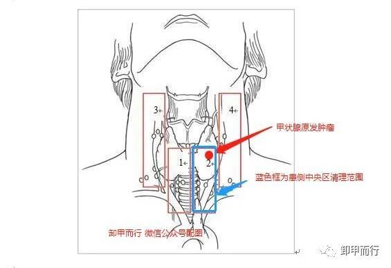 【图说09】满分的甲状腺癌颈部中央区(vi区)淋巴结清扫是什么样的?