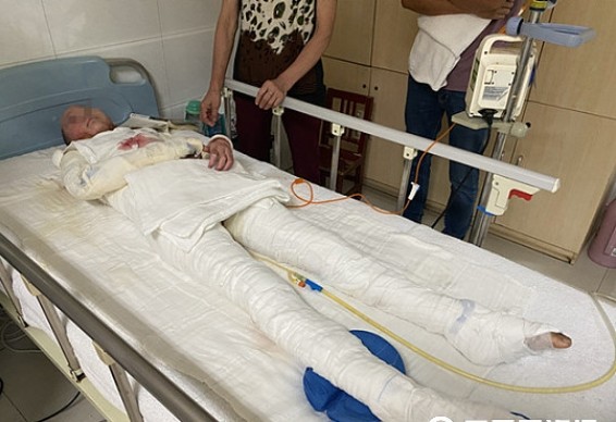 求助安康11岁女孩玩甲醇不慎烧伤全身仍想跳舞当舞蹈家