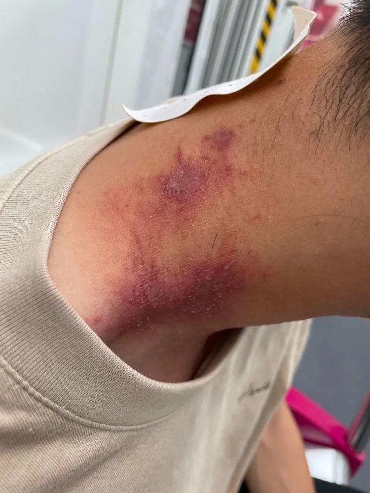 又痛又痒杭州小伙被这种虫子毒伤还起水泡医生提醒近期高发