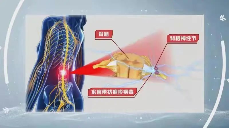 身体疼痛莫忽视远离疱疹守健康丨健康之路