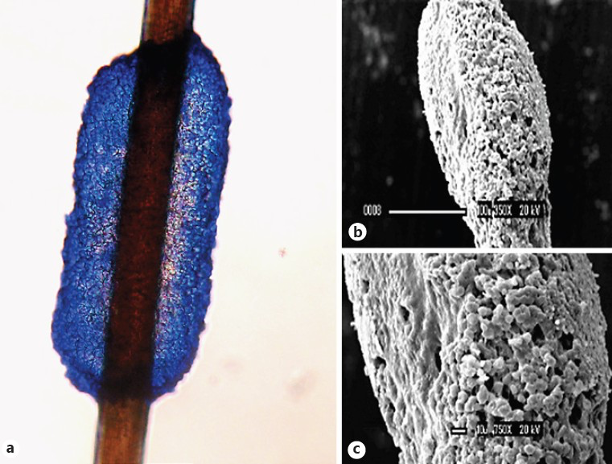 孢子形成的不规则形结节(见图 4a),与头癣不同,wp 的致病菌不穿透毛发