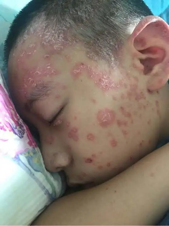 玫瑰痤疮脂溢性皮炎的发病率也是非常
