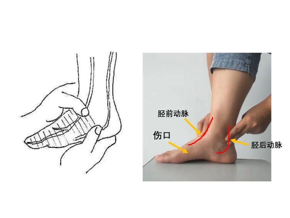 用加壓包紮或其他方法不能有效止血時