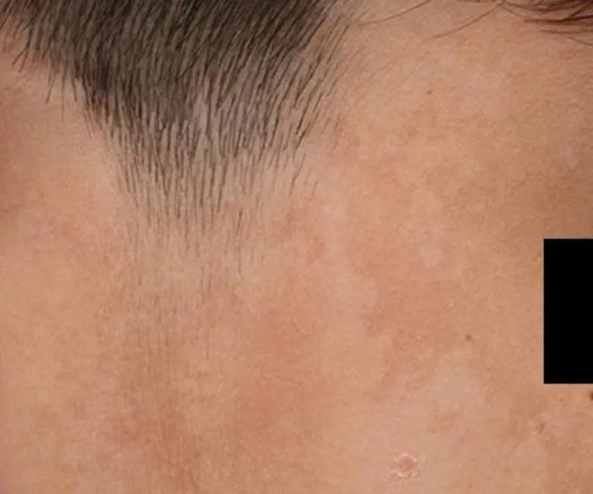 身上突然白了一块会不会是别慌教你几招轻松辨别白斑