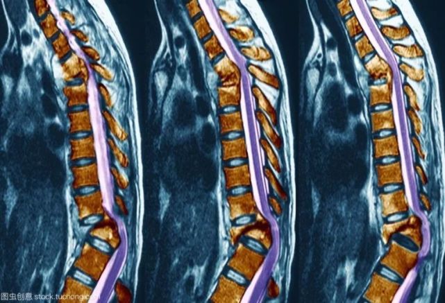 【医学科普】蓄力冬奥保障 急救脊柱外伤|脊柱|医学|外伤|脊柱损伤