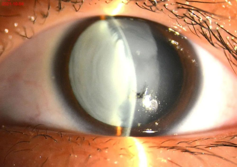 小翔施行了"左眼白内障超声乳化吸出 人工晶体植入 前段玻璃体切割术"