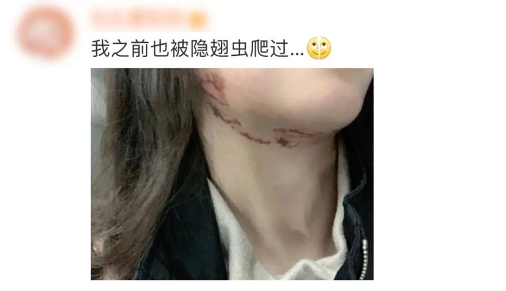 这种虫子毒液堪比硫酸飞到身上千万别拍