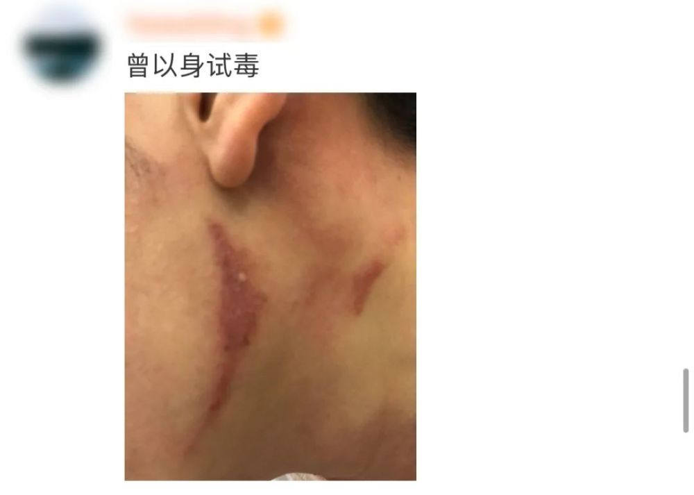 这种虫子毒液堪比硫酸飞到身上千万别拍