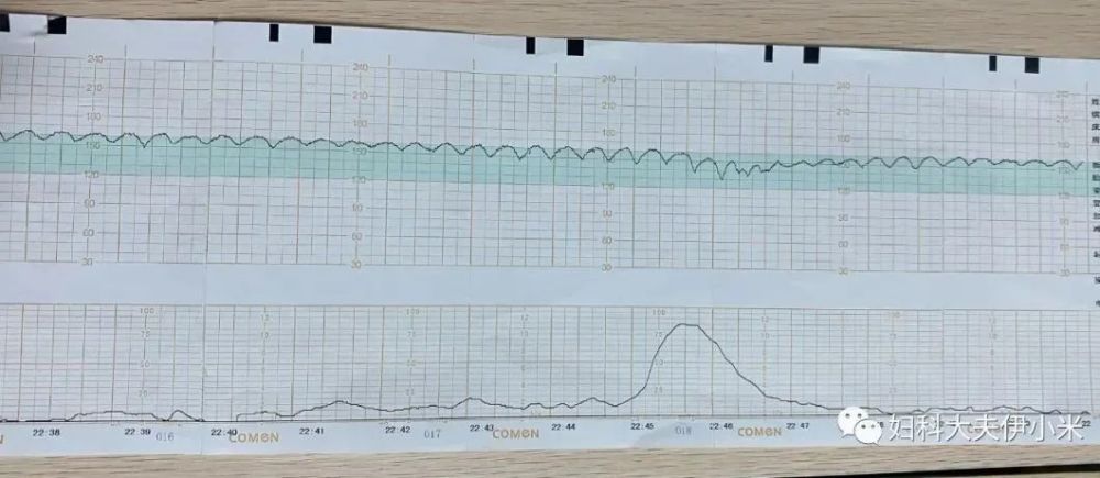 跑到产房门口,换鞋的刹那,看到了那张胎监图,乖乖,如假包换的正弦波