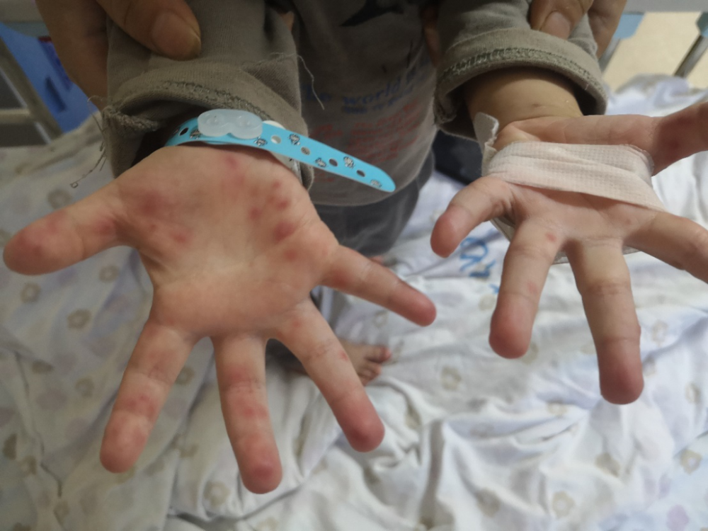 秋季手足口病进入高发期这份幼儿预防指南转给家长